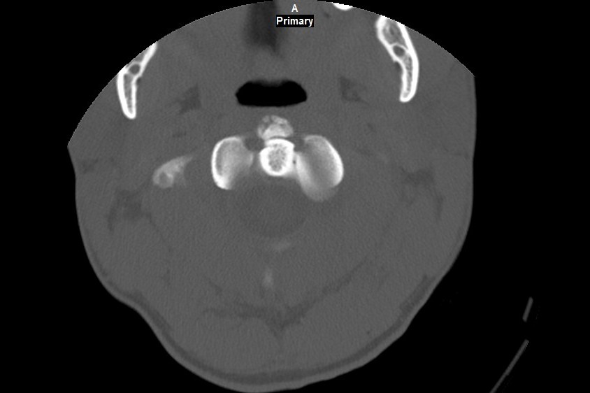 Accessory ossicle of the anterior arch of C1 vertebra | Image ...