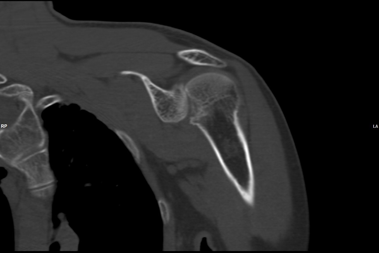 Posterior shoulder dislocation | Image | Radiopaedia.org