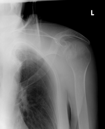 Posterior shoulder dislocation | Radiology Reference Article ...