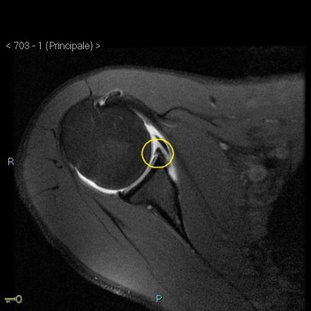 GLAD lesion | Radiology Case | Radiopaedia.org