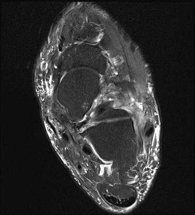 Tibialis posterior tendon rupture and sinus tarsi synovitis | Radiology ...