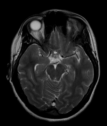 Arachnoid granulation (straight sinus) | Image | Radiopaedia.org