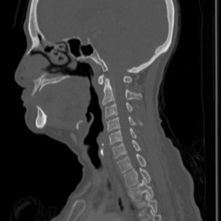 Cricoid plate ossification mimicking an impacted foreign body | Image ...