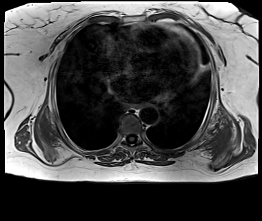 Elastofibroma Dorsi | Image | Radiopaedia.org