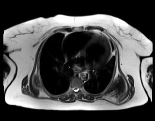 Elastofibroma Dorsi | Image | Radiopaedia.org