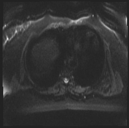 Elastofibroma Dorsi | Image | Radiopaedia.org