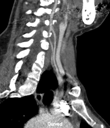 Fenestration of vertebral artery | Image | Radiopaedia.org