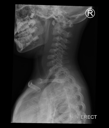 neck stretching x ray