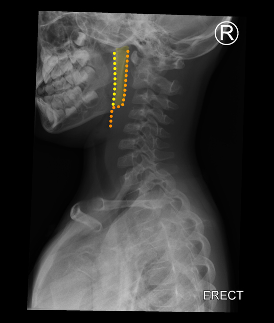 neck stretching x ray