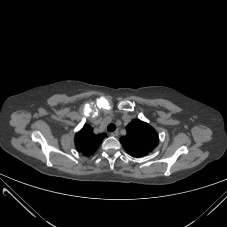 SAPHO syndrome | Image | Radiopaedia.org