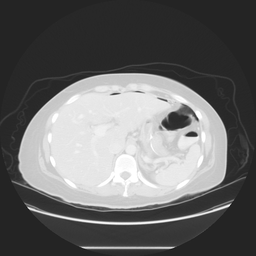 Pneumatosis intestinalis with pneumoperitoneum | Image | Radiopaedia.org