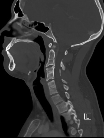 Klippel-Feil syndrome | Radiology Reference Article | Radiopaedia.org