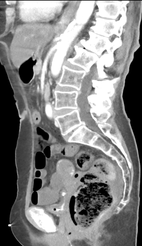 Bowel ischemia | Image | Radiopaedia.org