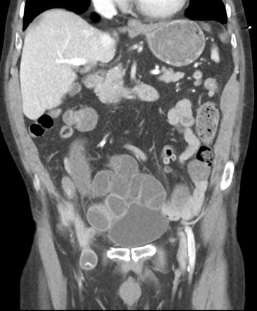 Small bowel obstruction secondary to femoral hernia | Image ...