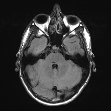 Spinal arteriovenous malformation | Image | Radiopaedia.org