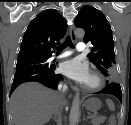 Organizing pneumonia | Image | Radiopaedia.org