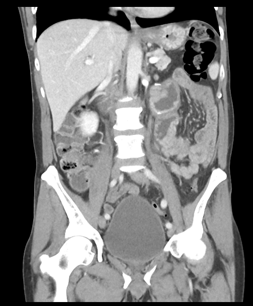 Small bowel melanoma recurrence | Image | Radiopaedia.org