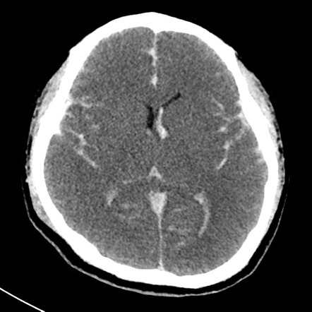 Subarachnoid hemorrhage and raised ICP | Image | Radiopaedia.org