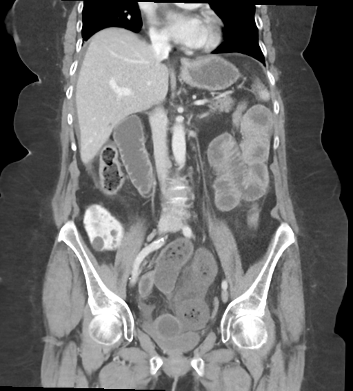 Closed loop small bowel obstruction | Image | Radiopaedia.org