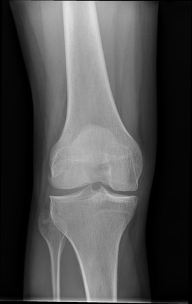 Discoid lateral meniscus | Image | Radiopaedia.org