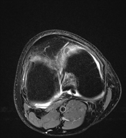 Discoid lateral meniscus | Image | Radiopaedia.org