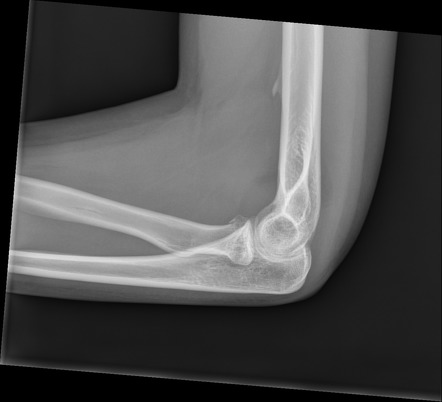 Supracondylar spur and radial head fracture | Image | Radiopaedia.org