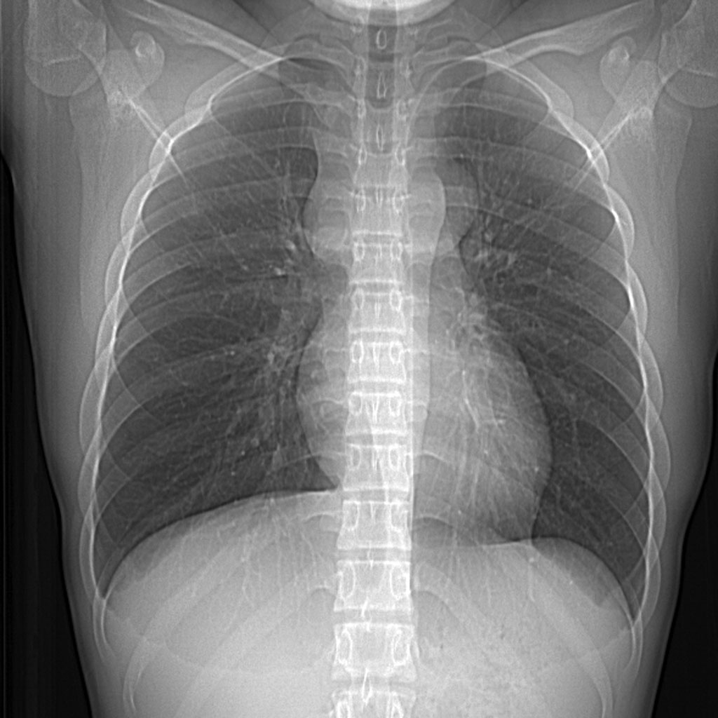 Д графия. Остеопороз ребер на рентгене. Thorax rentgenographia. Средостения грудной клетки рентген. Рентген костей грудной клетки.