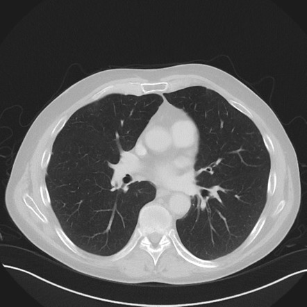 Multifocal lung adenocarcinoma | Radiology Case | Radiopaedia.org