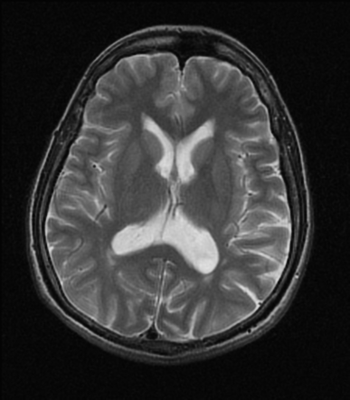 Otogenic meningoencephalocele | Radiology Case | Radiopaedia.org