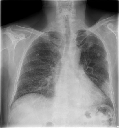 Organizing pneumonia | Image | Radiopaedia.org