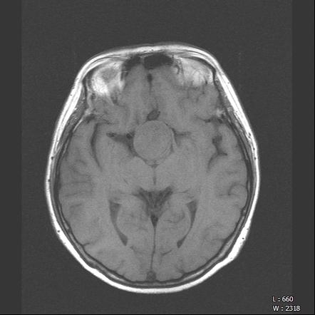 Pituitary Apoplexy With Pituitary Macroadenoma | Image | Radiopaedia.org