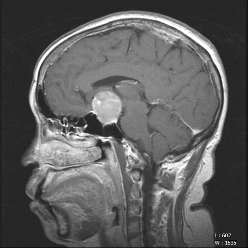 Pituitary Apoplexy With Pituitary Macroadenoma | Image | Radiopaedia.org