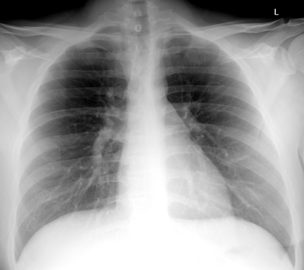 Rhomboid fossa of the clavicle | Radiology Reference Article ...