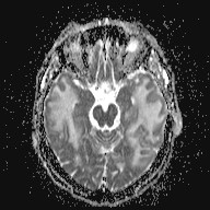 Cerebral Amyloid Angiopathy-related Inflammation | Image | Radiopaedia.org