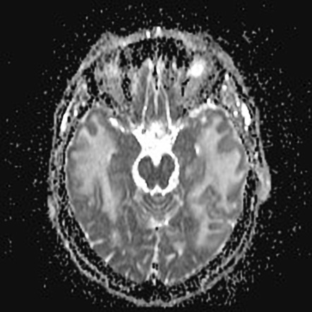 Cerebral amyloid angiopathy-related inflammation | Image | Radiopaedia.org