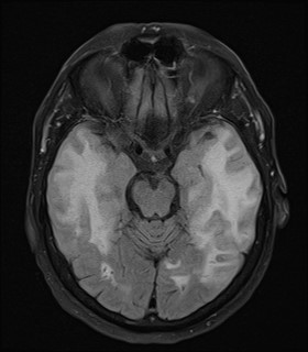 Cerebral Amyloid Angiopathy-related Inflammation | Image | Radiopaedia.org