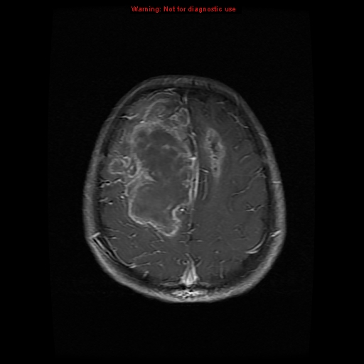 Embryonal tumor with multilayered rosettes (ETMR) | Image | Radiopaedia.org