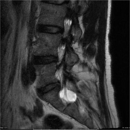 Classification of spinal meningeal cysts | Radiology Reference Article ...