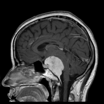 Clival masses | Radiology Reference Article | Radiopaedia.org