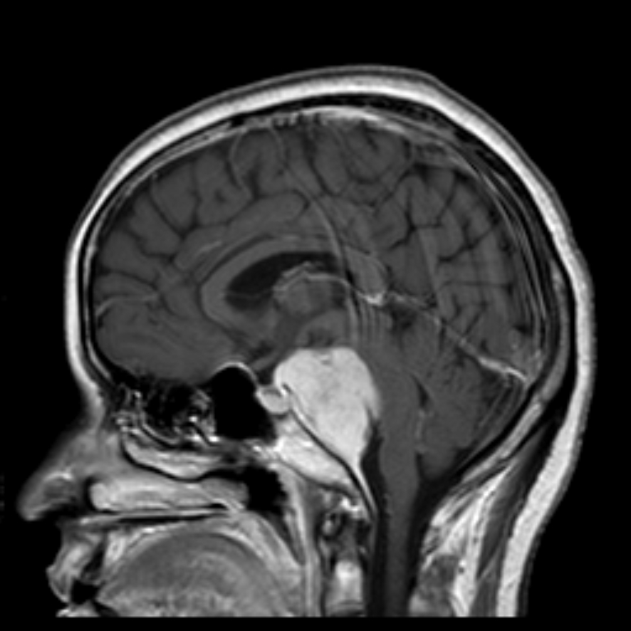 Clival meningioma | Image | Radiopaedia.org