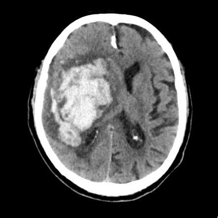 Basal ganglia hemorrhage | Image | Radiopaedia.org