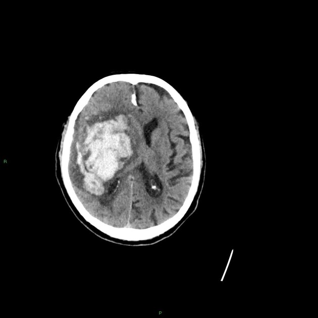 Basal Ganglia Hemorrhage Radiology Case Radiopaedia Org