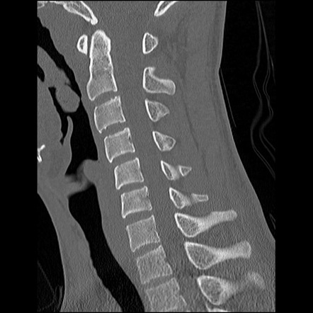 C5 Facet Fracture 