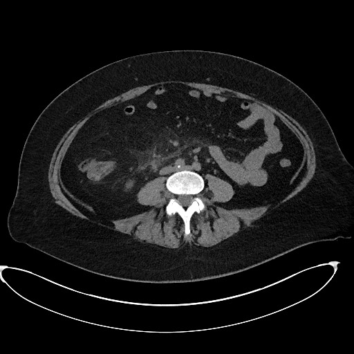 Perforated Appendicitis With Periappendiceal Abscess Image 5022