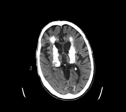 Viewing playlist: MRT Hirn | Radiopaedia.org