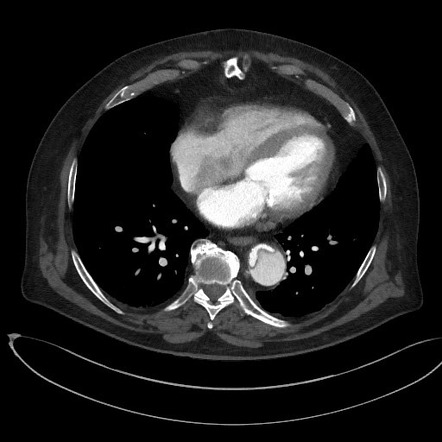 Ruptured Stanford type A aortic dissection | Image | Radiopaedia.org