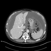 Pseudomyxoma Peritonei Radiology Reference Article Radiopaedia Org