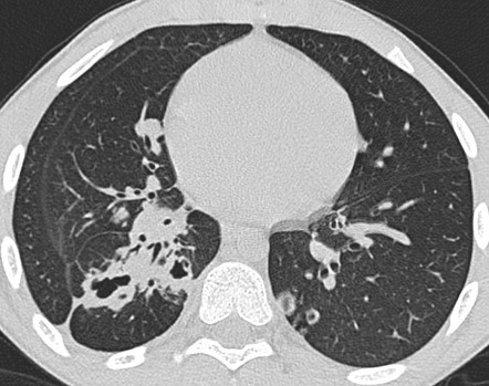 Recurrent Respiratory Papillomatosis Radiology Reference Article Radiopaedia Org