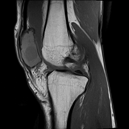 Giant cell tumor: patella | Image | Radiopaedia.org