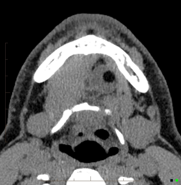 Floor Of Mouth Dermoid Cyst Radiology Case Radiopaedia Org